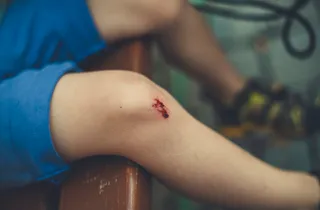 Nahaufnahme eines aufgeschürften Knies eines Kindes in blauer Shorts.